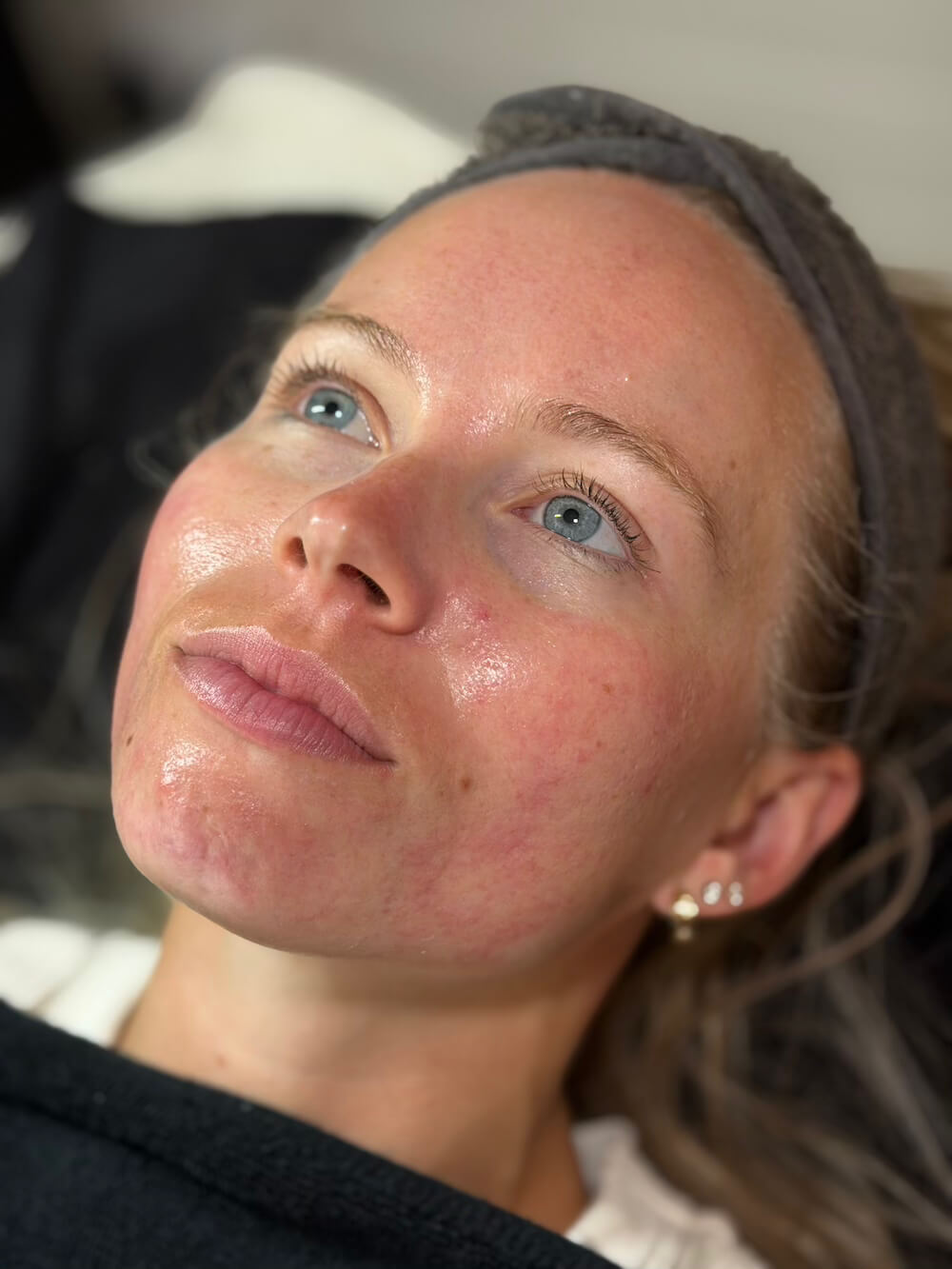 Fresh skin following considered professional treatment and homecare